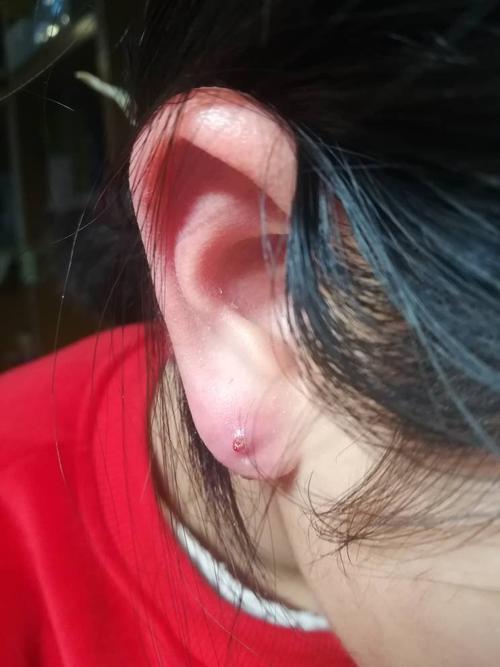 耳洞灌脓之后长成了个小包,怎么办,是不是只要用酒精和红霉素软膏涂就