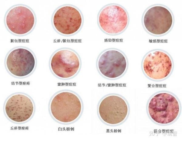 有什么好的方法可以祛痘让皮肤变好