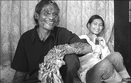 印尼怪人全身长"树根"