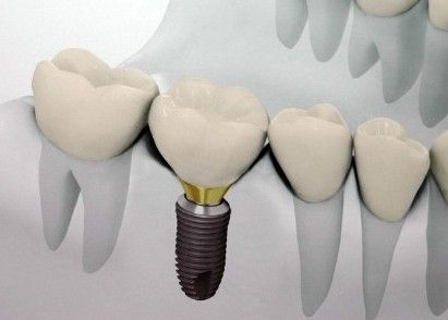 韩国种植牙的优点有哪些?