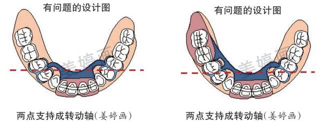 上颌前牙舌隆突支托未形成 牙合力