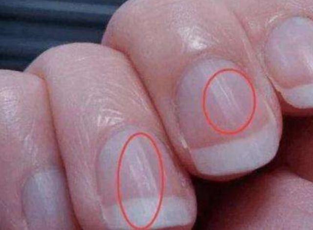所以当你的指甲上出现竖纹的时候,看看自己是否患有缺铁性贫血了,如果