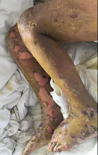 郓城诚信医院肛肠外科治愈一例严重天疱疮患者