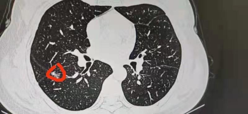 患者肺部ct影像显示结节