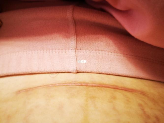 剖腹产疤痕增生_疤痕_剖腹产_剖腹产疤痕_母婴_妈妈