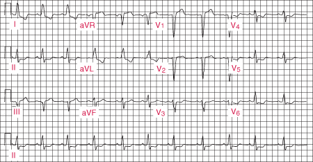 左束支传导阻滞