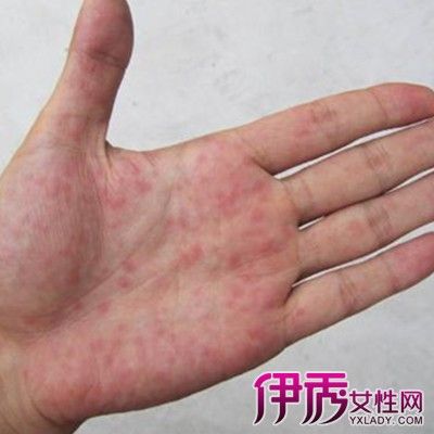 【图】揭秘手掌出现红点原因 日常生活需注重饮食与休息问题
