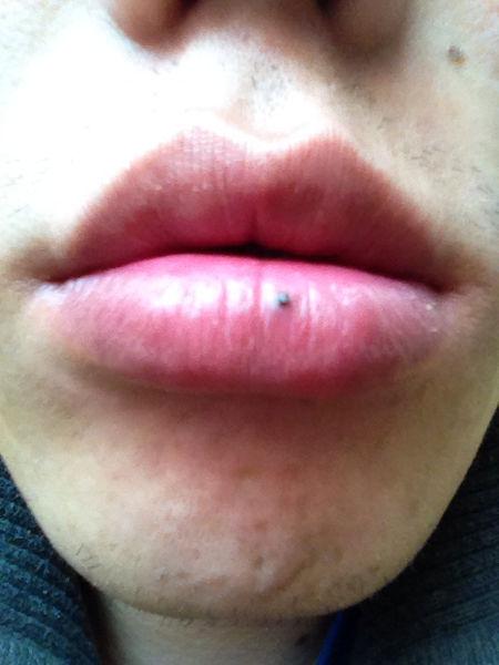 请问这是血管瘤吗?要怎么处理!谢谢!