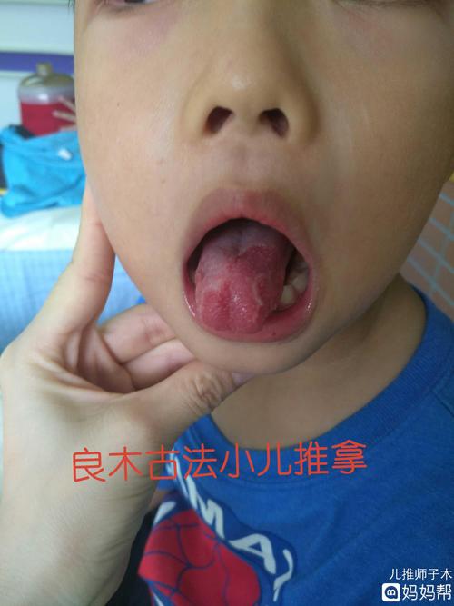 什么是地图舌?
