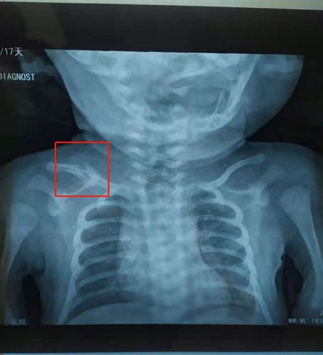 新生儿锁骨骨折家属索赔万元遭拒医院属分娩风险