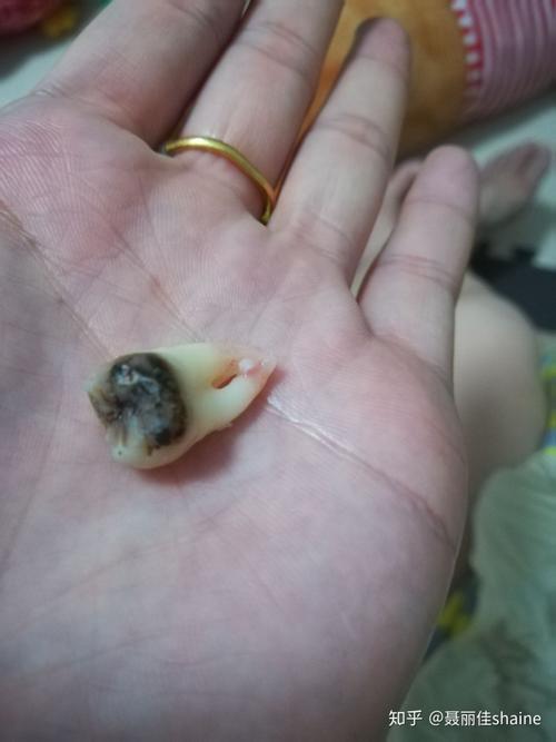 这是今天拔的两颗智齿.