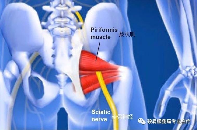梨状肌炎症消除,解除坐骨神经压迫 下肢疼痛缓解.