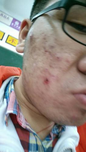 先不管痘坑,请问脸上那些毒疮(应该不是普通的青春痘了,挤爆后一大堆