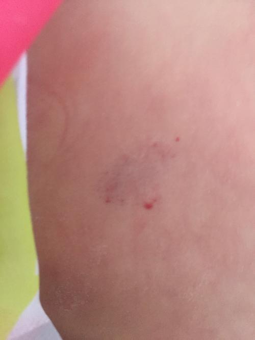 宝宝后背紫了,好久了,估计快俩月了.