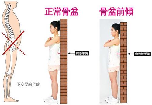 简单2步改善产后骨盆前倾