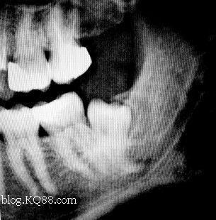 (五)x片显示牙根极度弯细, 牙骨质增生或存在根内或根外吸收.