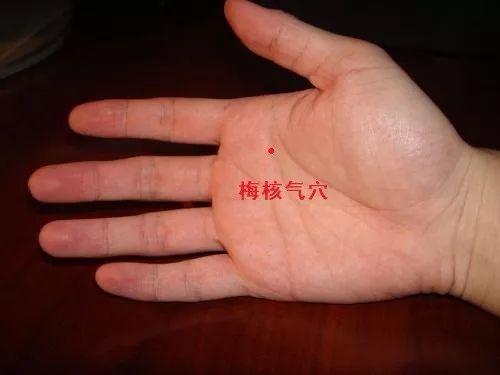 一针一穴治疗梅核气