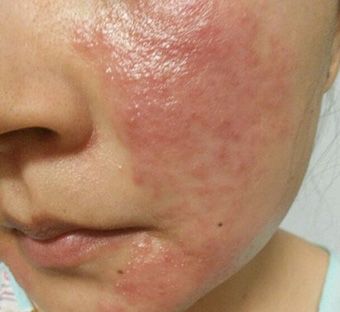 面部湿热性的过敏湿疹图片