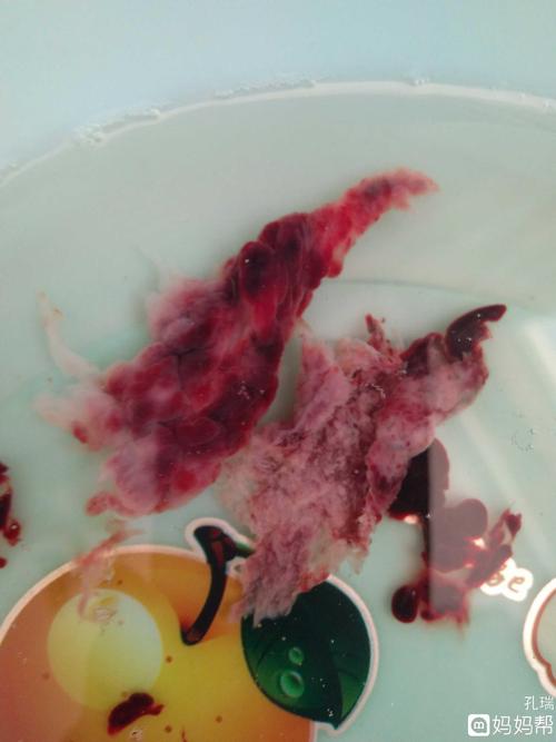 流产第二天,看看掉下来什么,求大家看一下掉干净了吗