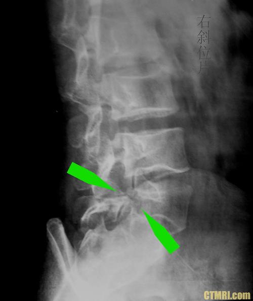 腰椎滑脱症综述附图解