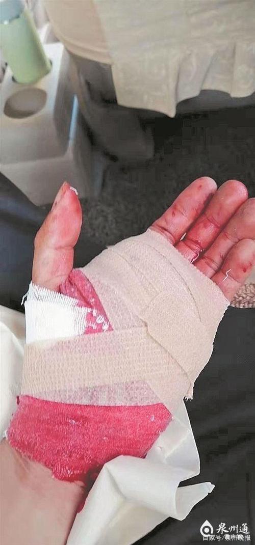 林海原手掌受伤