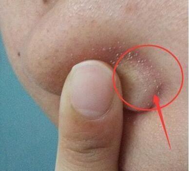 鼻子上有粉刺黑土怎么办?三个小妙招皮更细腻