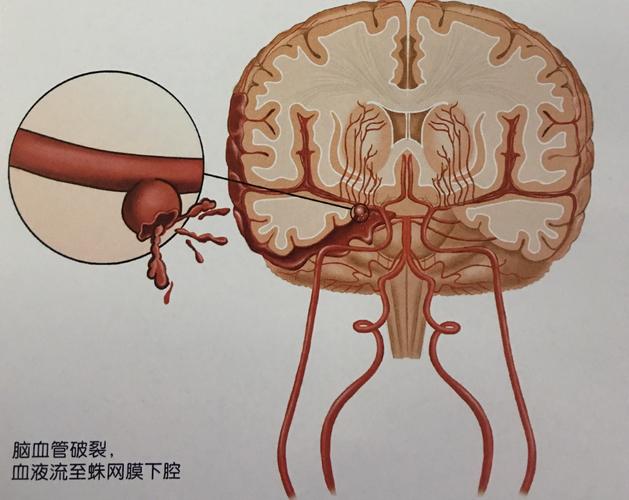 蛛网膜下腔出血