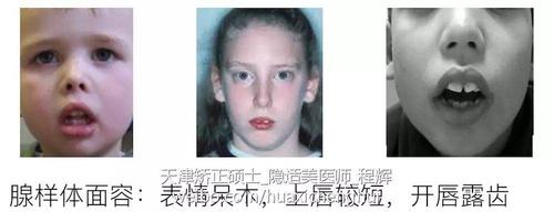 儿童口呼吸的危害