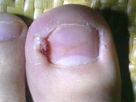 我的左脚脚趾头发炎了,就像图片那样,有什么办法可以解决