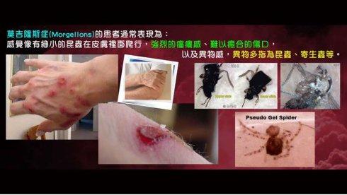 将人体变成工厂-莫吉隆斯症