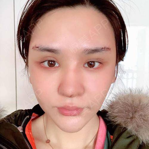 假体垫眉弓术后4天_隆眉弓术后4天_面部轮廓术后4天_悦mer_9279712910