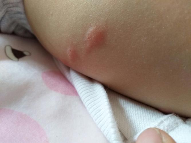 宝宝一痒就把疙瘩抓破了!疙瘩里一挤都有水 !