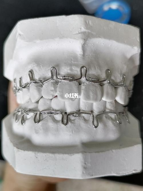 第一次牙弓夹板制作圆满完成!撒花撒花~_夹板_医学生