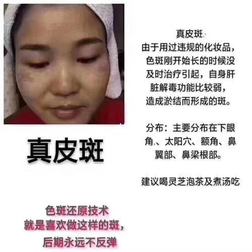 什么叫真皮斑?