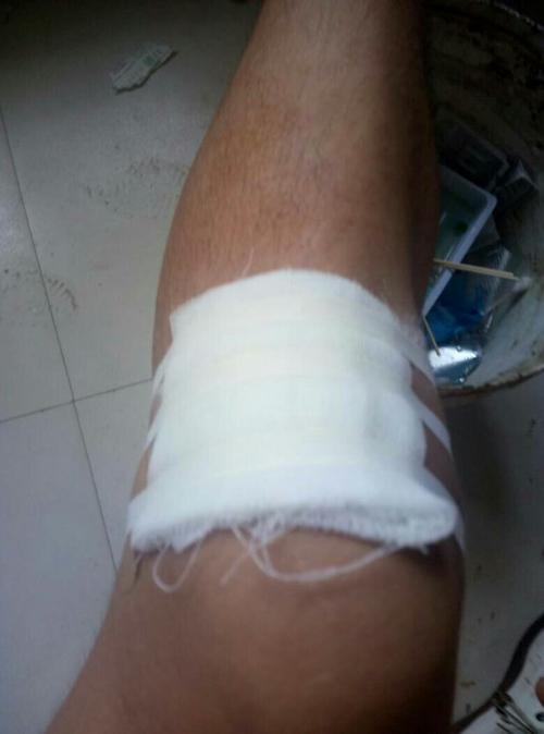 去医务室包扎完还去逛了超市,现在只能缓慢弯曲,是不是腿摔断了