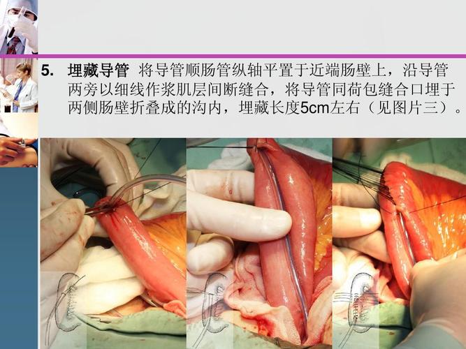 空肠造瘘术ppt