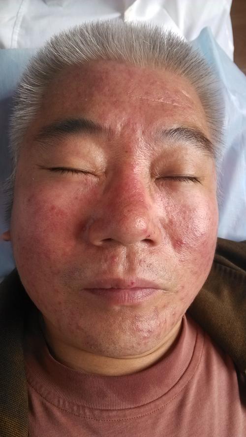 脂溢性皮炎中药面膜治疗