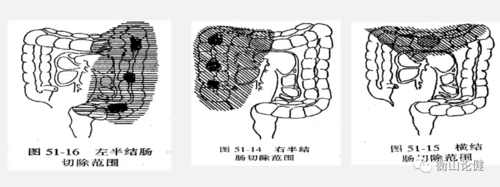 菜花状或息肉状充盈缺损,外缘不规整,境界清楚,局部粘膜皱襞破坏消失