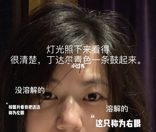 泪沟玻尿酸丁达尔挑战魔鬼溶解酶第二次2_泪沟_玻尿酸