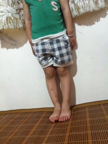 小孩走路内八,这是罗圈腿丶o型腿腿或x型腿吗?需要矫正吗?还是正常的?