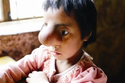 不幸女孩脸上长个瘤子