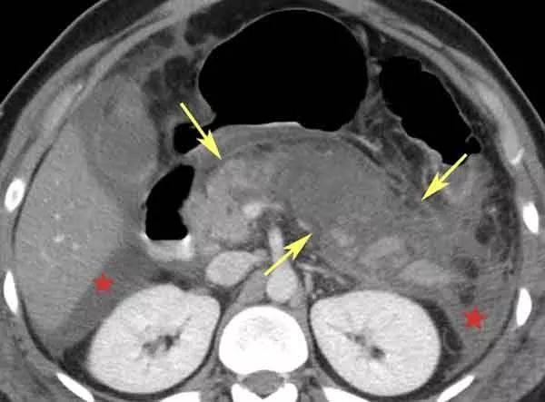 案例结果:急性胰腺炎