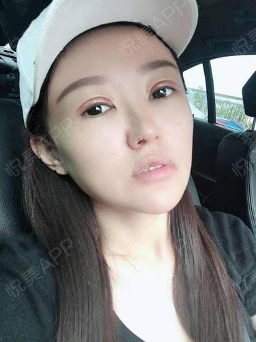 全切双眼皮术后7天_眼综合术后7天_双眼皮术后7天_眼部术后7天_兔兔