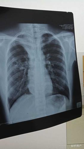 肺结核有多恐怖?