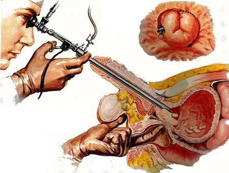 输尿管结石的三种治疗方法