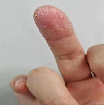5岁小朋友指头脱皮湿疹图片