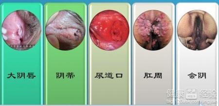 湿疣可以划分为许多种类,比如说是宫颈湿疣,肛门尖锐湿疣等.