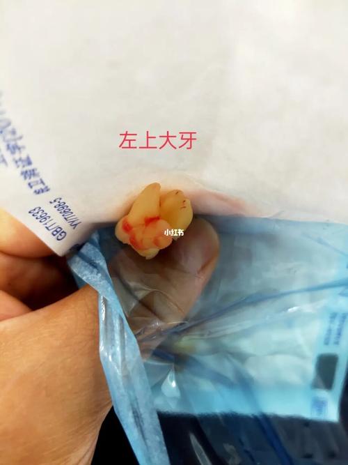 拔智齿_智齿_拔牙_医疗健康_医疗健康其他