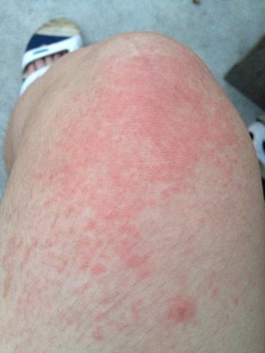 2014-07-02 吕宇辉 主治医生 身上许多密密麻麻的小红点,像湿疹又像