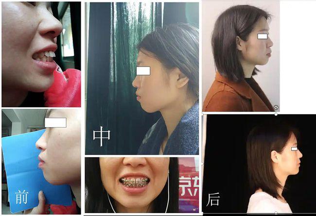 今天就一起跟大家分享一下 @ysyfy39 拔牙7颗,三颗智齿,四个四号牙